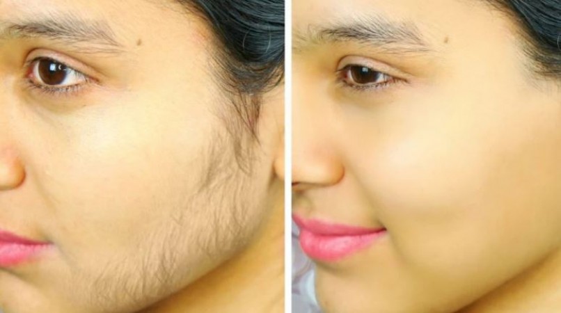 வீட்டில் இருந்தபடியே முகத்தில் இருக்கும் தேவையற்ற முடிகளை சுலபமாக அகற்றிடலாம்...